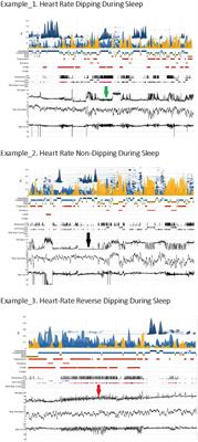 Cardiopulmonary coupling-calculated sleep stability and nocturnal heart rate kinetics as a potential indicator for cardiovascular health: a relationship with blood pressure dipping